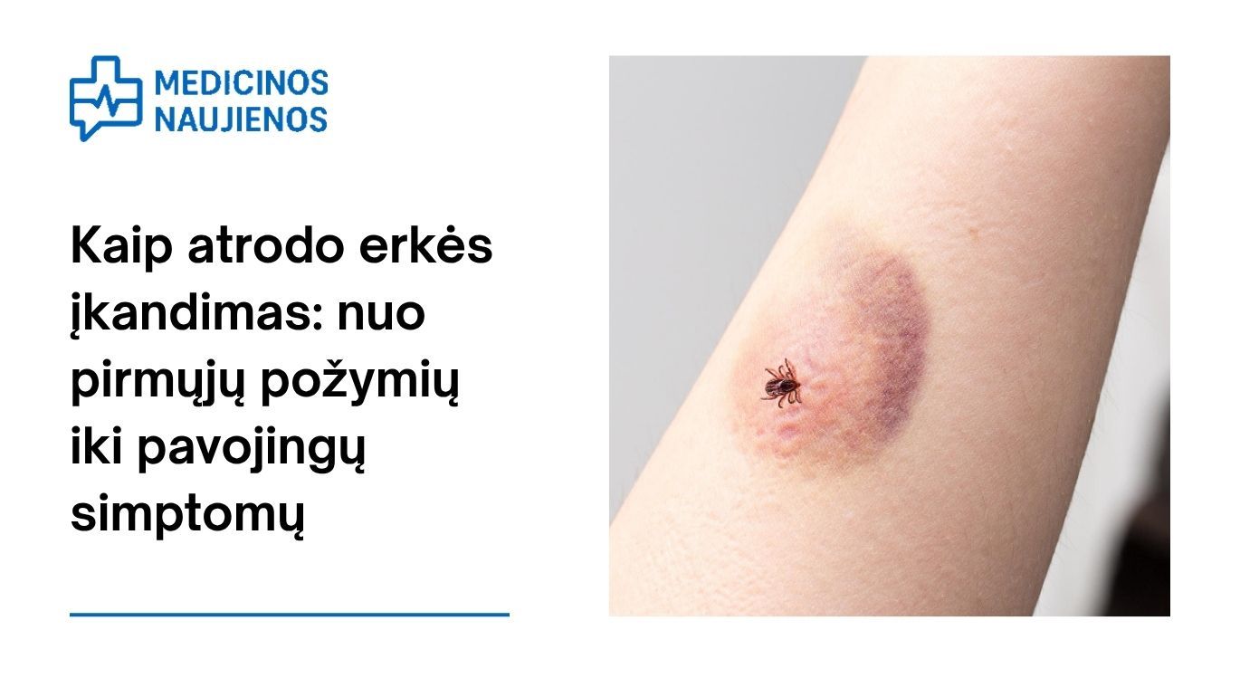 Kaip atrodo erkės įkandimas: nuo pirmųjų požymių iki pavojingų simptomų