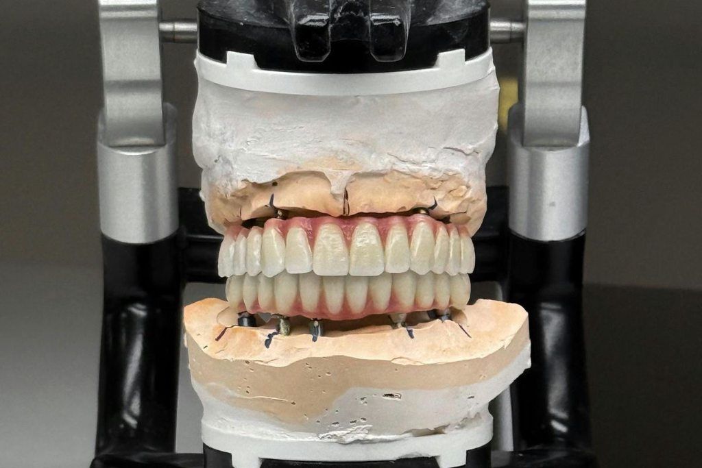 Kas yra viso žandikaulio implantacija ir kuo ji skiriasi nuo All on 4