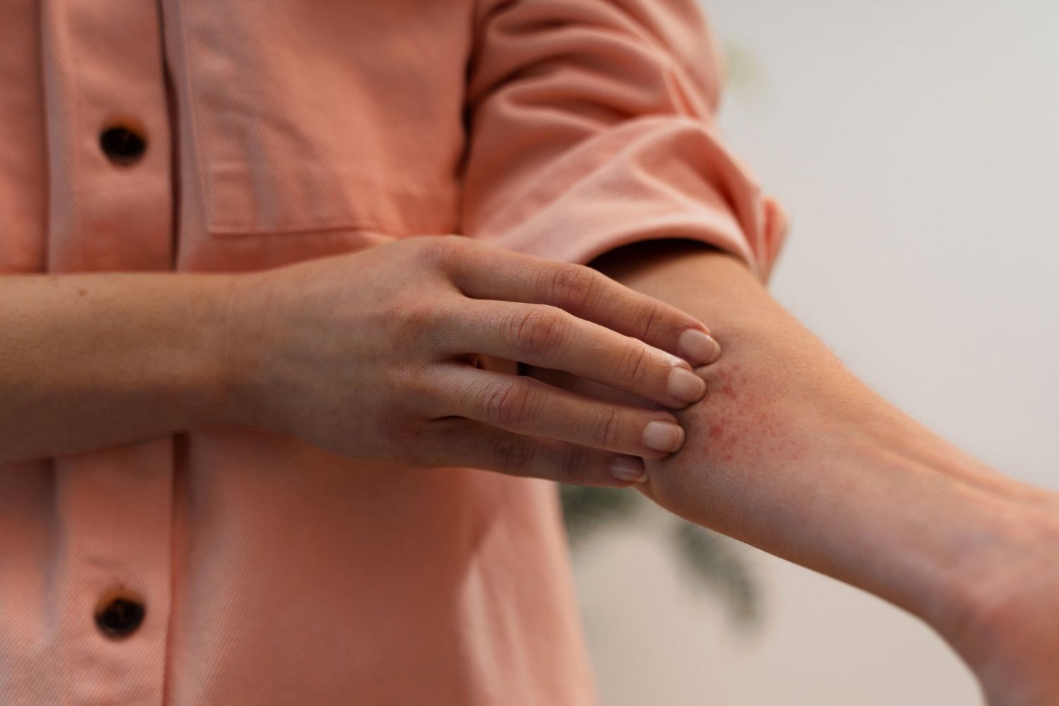 Psoriazė: Simptomai, priežastys, gydymas, prevencija