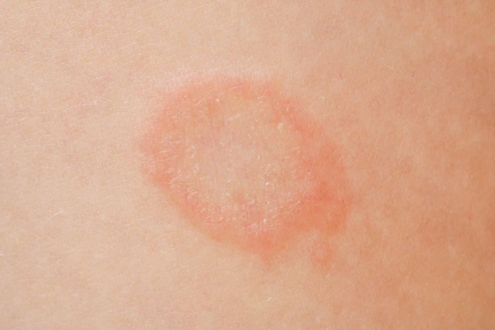 Žieduotoji pūslelinė ir kitos grybelinės infekcijos: Simptomai, priežastys, gydymas, prevencija