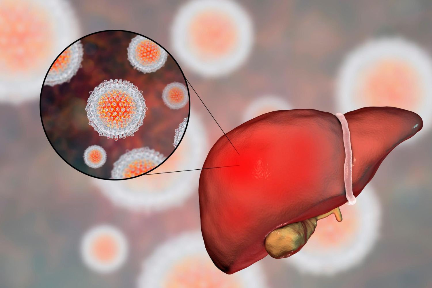 Hepatitas A: simptomai, priežastys, gydymas, prevencija