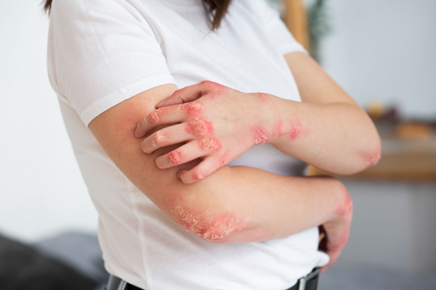 Žvynelinė: Simptomai, priežastys, gydymas, prevencija