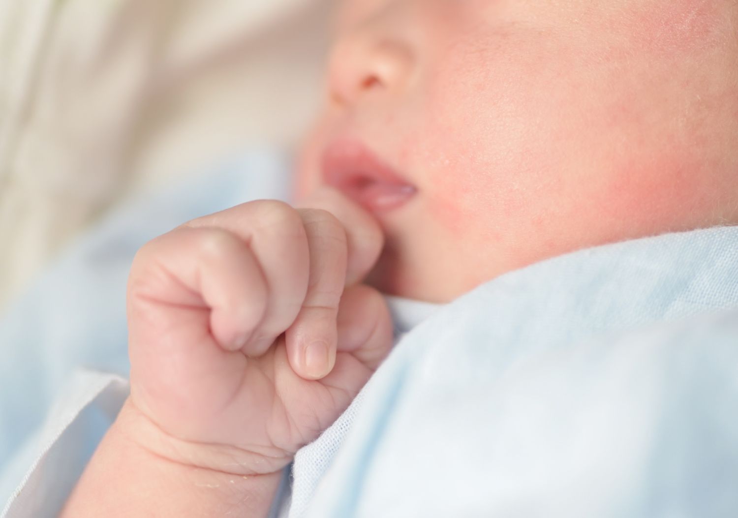 Impetiga: simptomai, priežastys, gydymas, prevencija