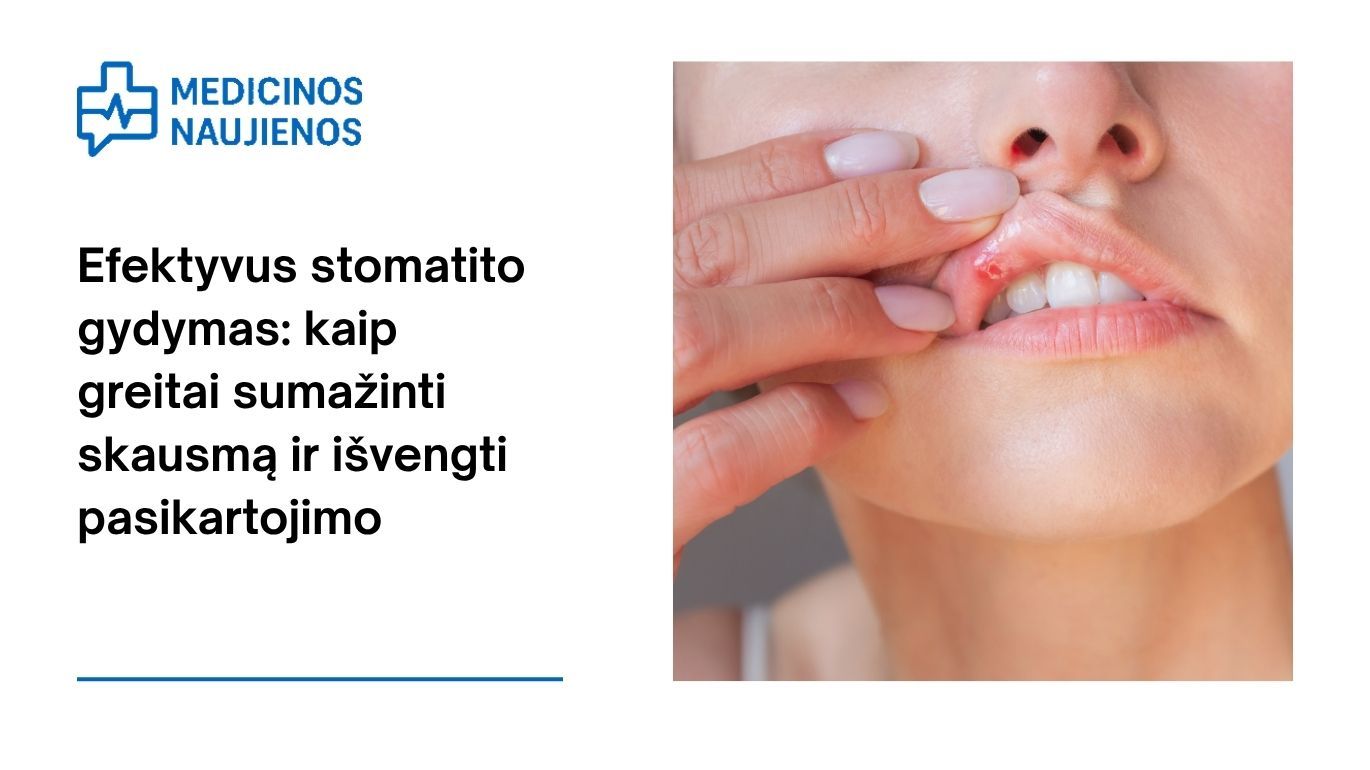 Efektyvus stomatito gydymas: kaip greitai sumažinti skausmą ir išvengti pasikartojimo