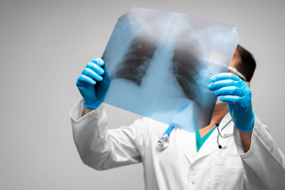 Asbestozė: Simptomai, priežastys, gydymas, prevencija