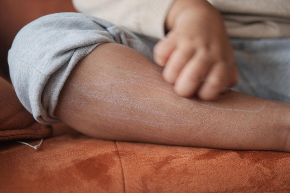 Angioneurozinė edema: simptomai, priežastys, gydymas, prevencija