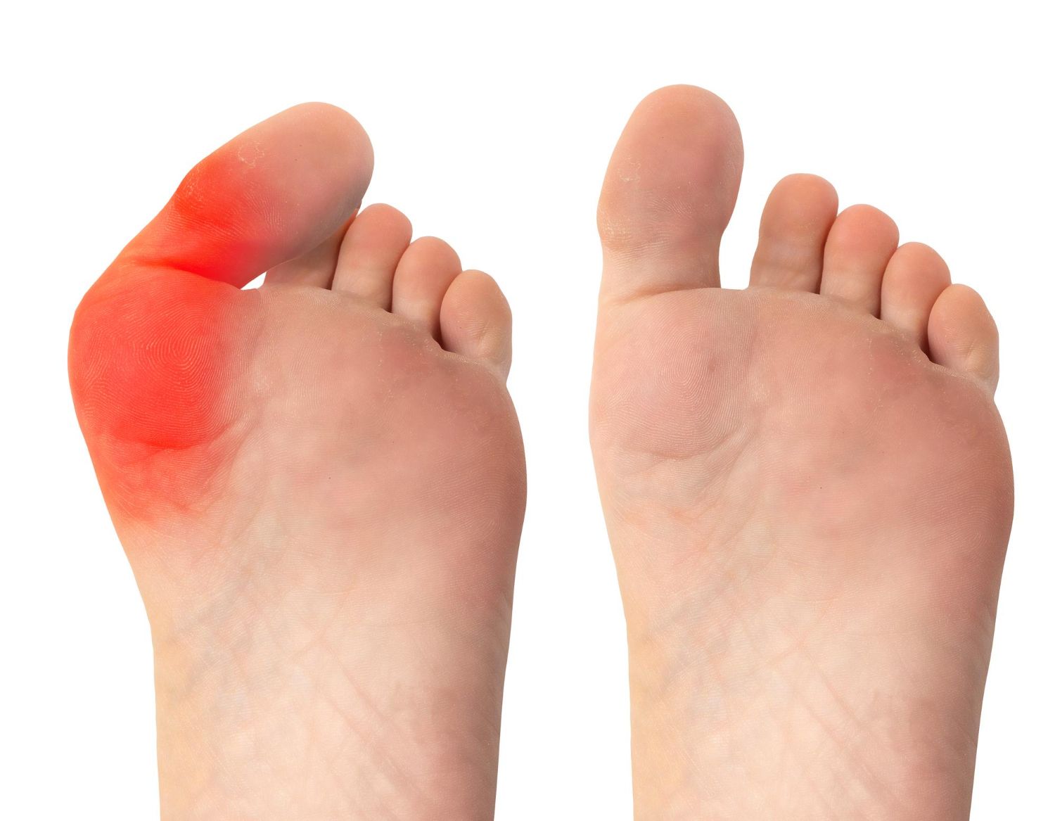 Hallux valgus deformacija: Simptomai, priežastys, gydymas, prevencija