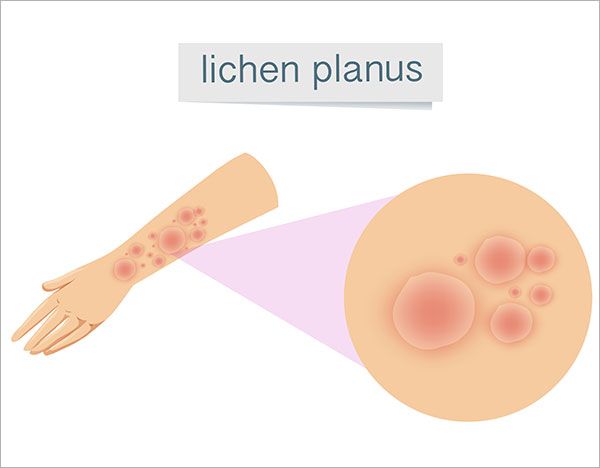 Plokščioji kerpligė: Simptomai, priežastys, gydymas, prevencija