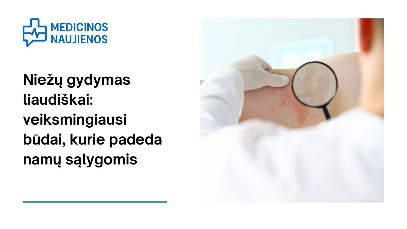 Niežų gydymas liaudiškai: veiksmingiausi būdai, kurie padeda namų sąlygomis