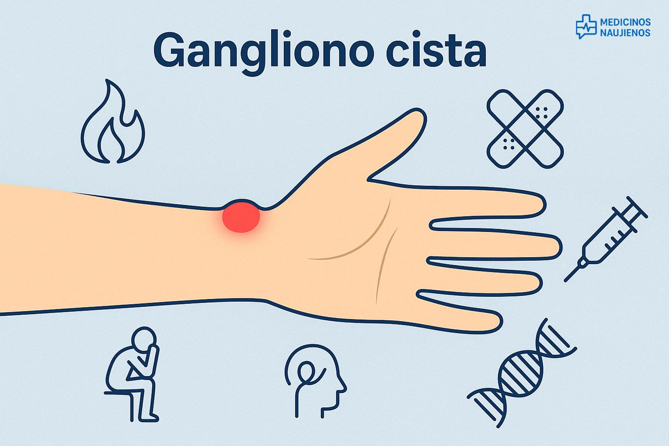 Gangliono cista: simptomai, priežastys, gydymas, prevencija