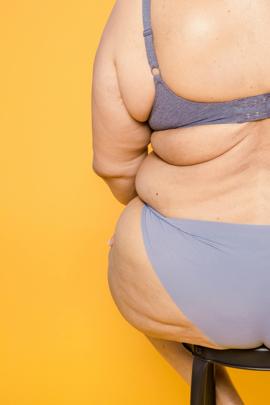 Lipedema: kai riebalai auga ne nuo persivalgymo