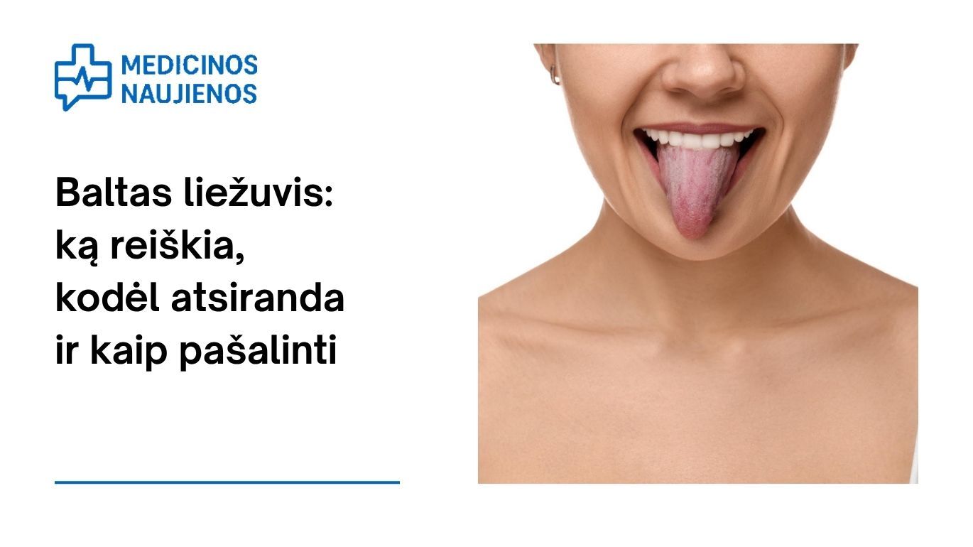 Baltas liežuvis: ką reiškia, kodėl atsiranda ir kaip pašalinti