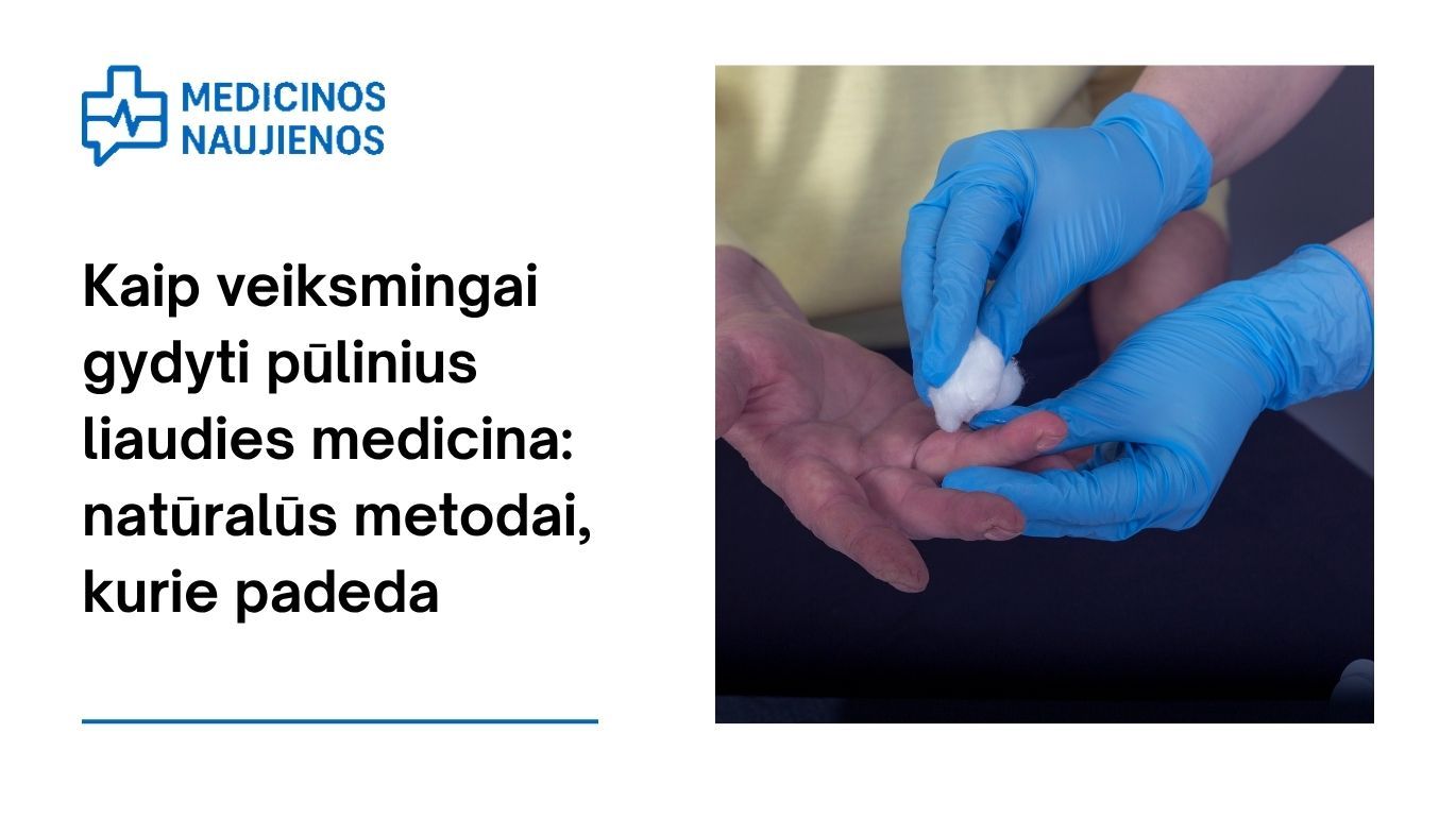Kaip veiksmingai gydyti pūlinius liaudies medicina: natūralūs metodai, kurie padeda