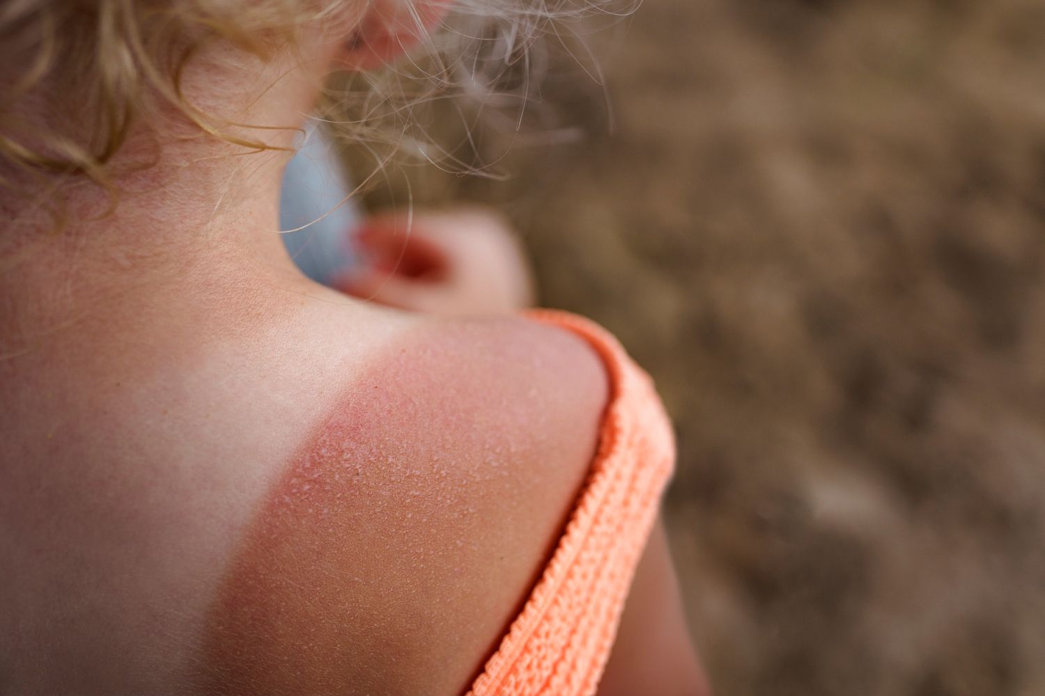Nudegimas saulėje: Simptomai, priežastys, gydymas, prevencija