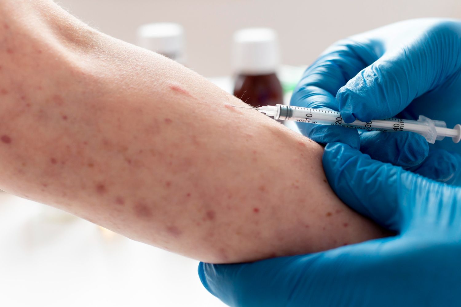 Limfogranuloma Venereum (LGV): Simptomai, priežastys, gydymas, prevencija