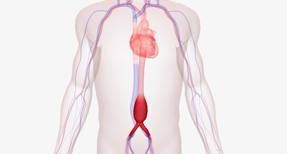 Pilvo aortos aneurizma: Simptomai, priežastys, gydymas, prevencija
