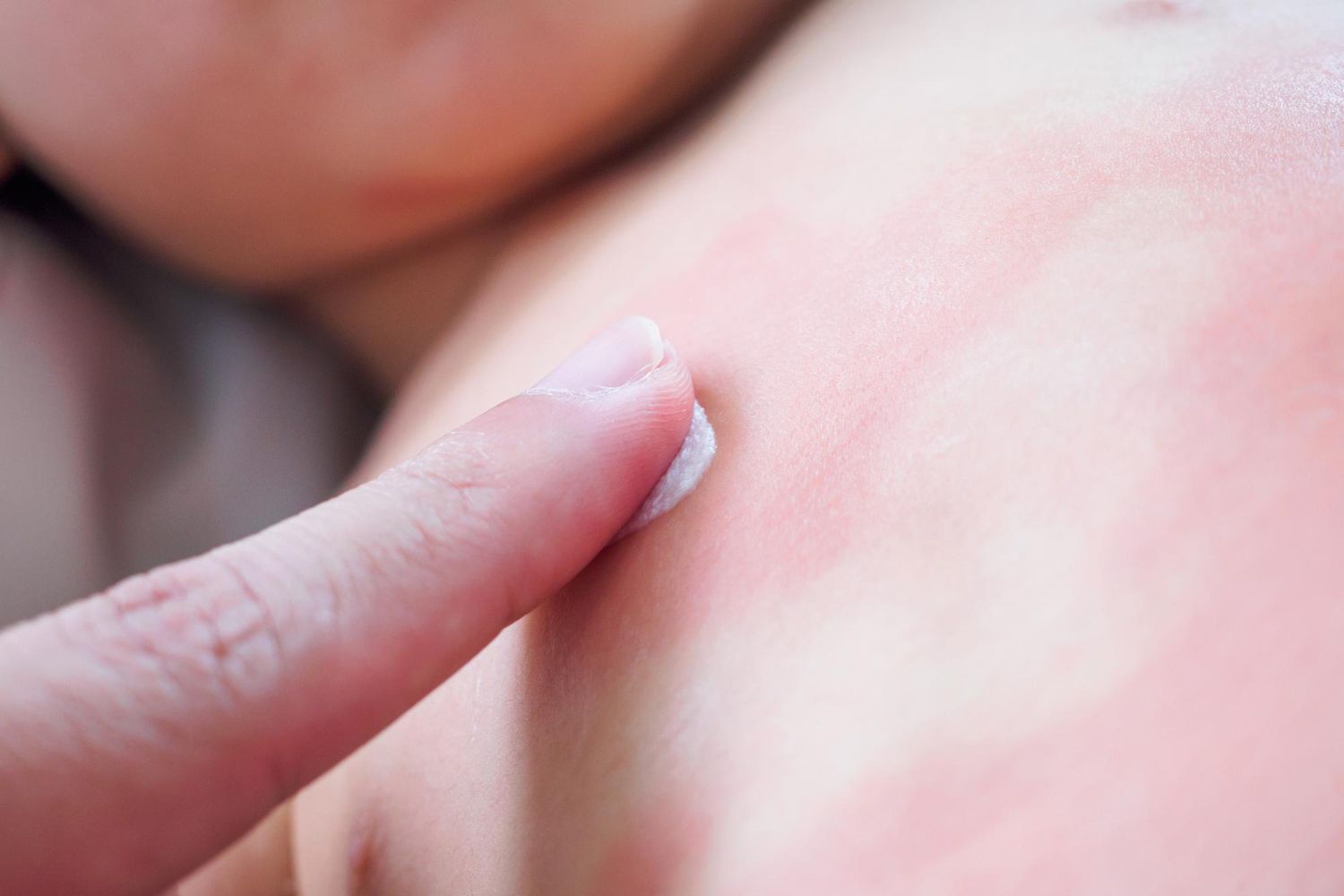 Atopinis dermatitas: simptomai, priežastys, gydymas