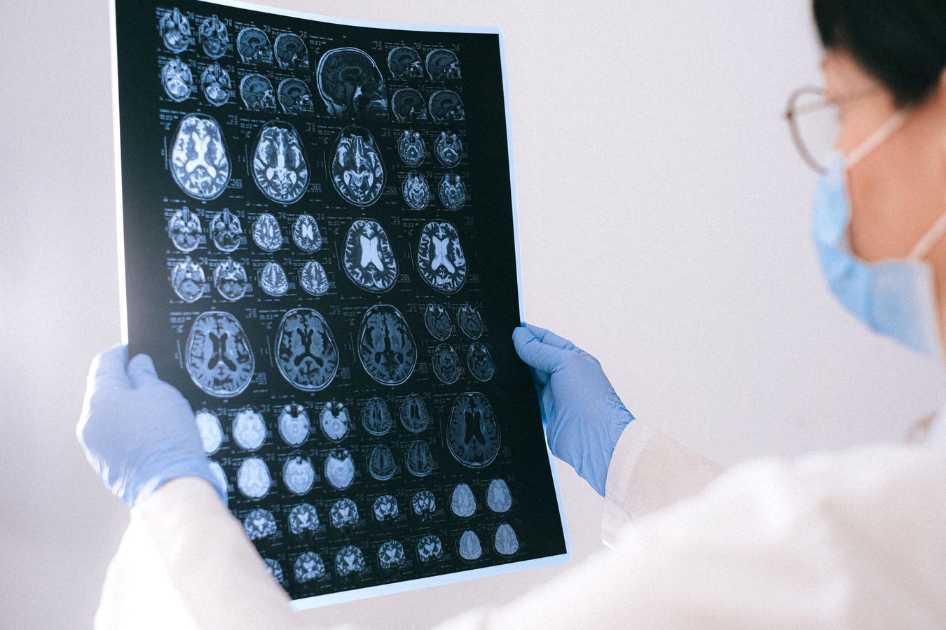 Alzheimerio liga: rasta užuomina, kaip žūsta smegenų ląstelės