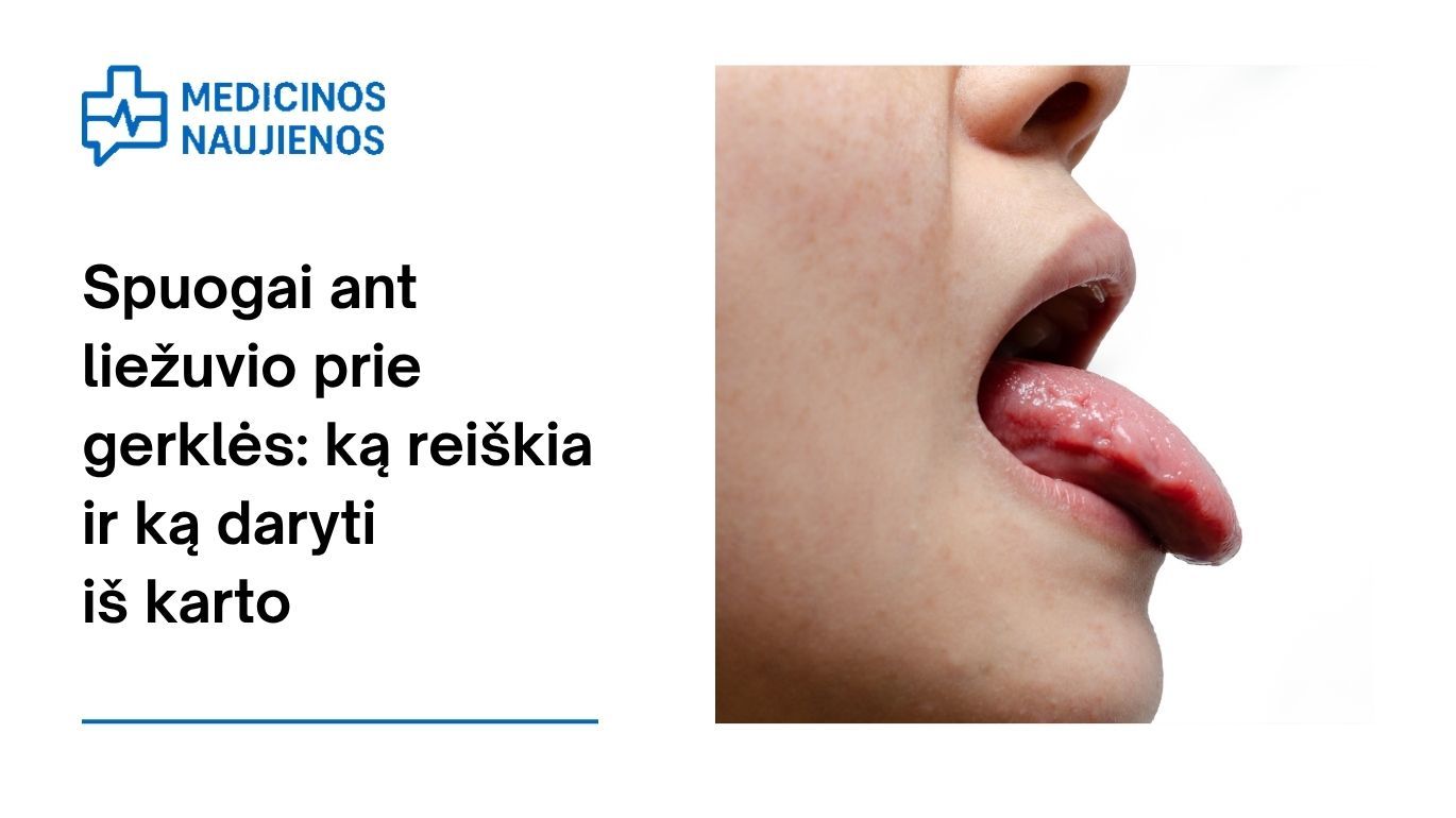 Spuogai ant liežuvio prie gerklės: ką reiškia ir ką daryti iš karto