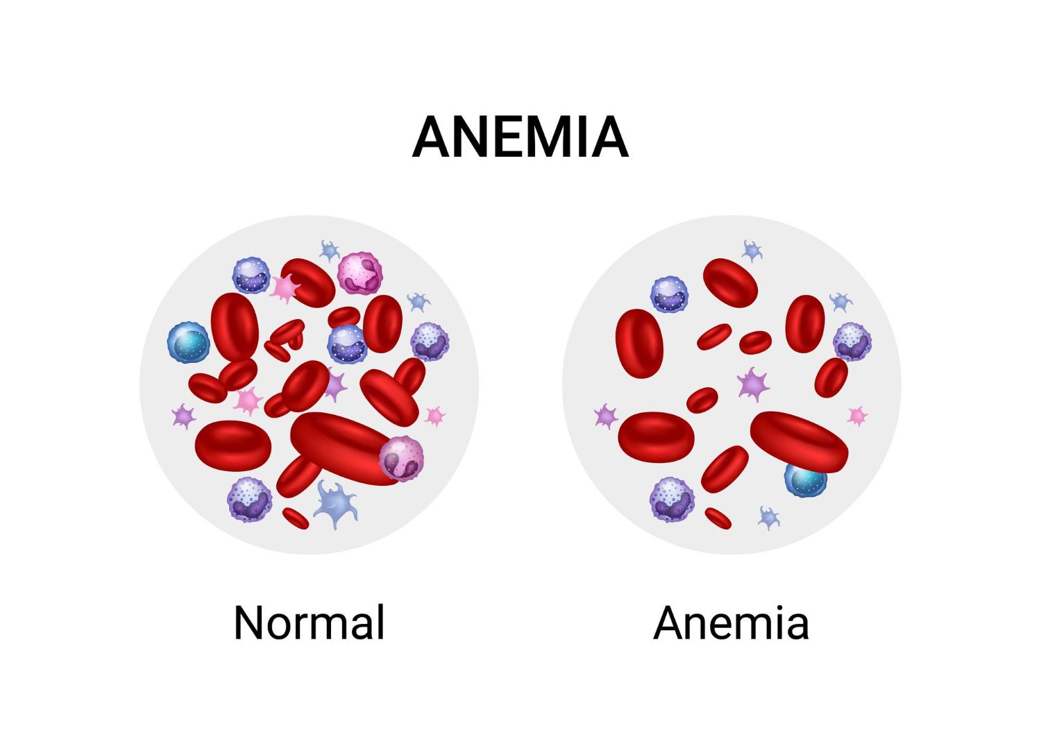 Anemija: simptomai, priežastys, gydymas