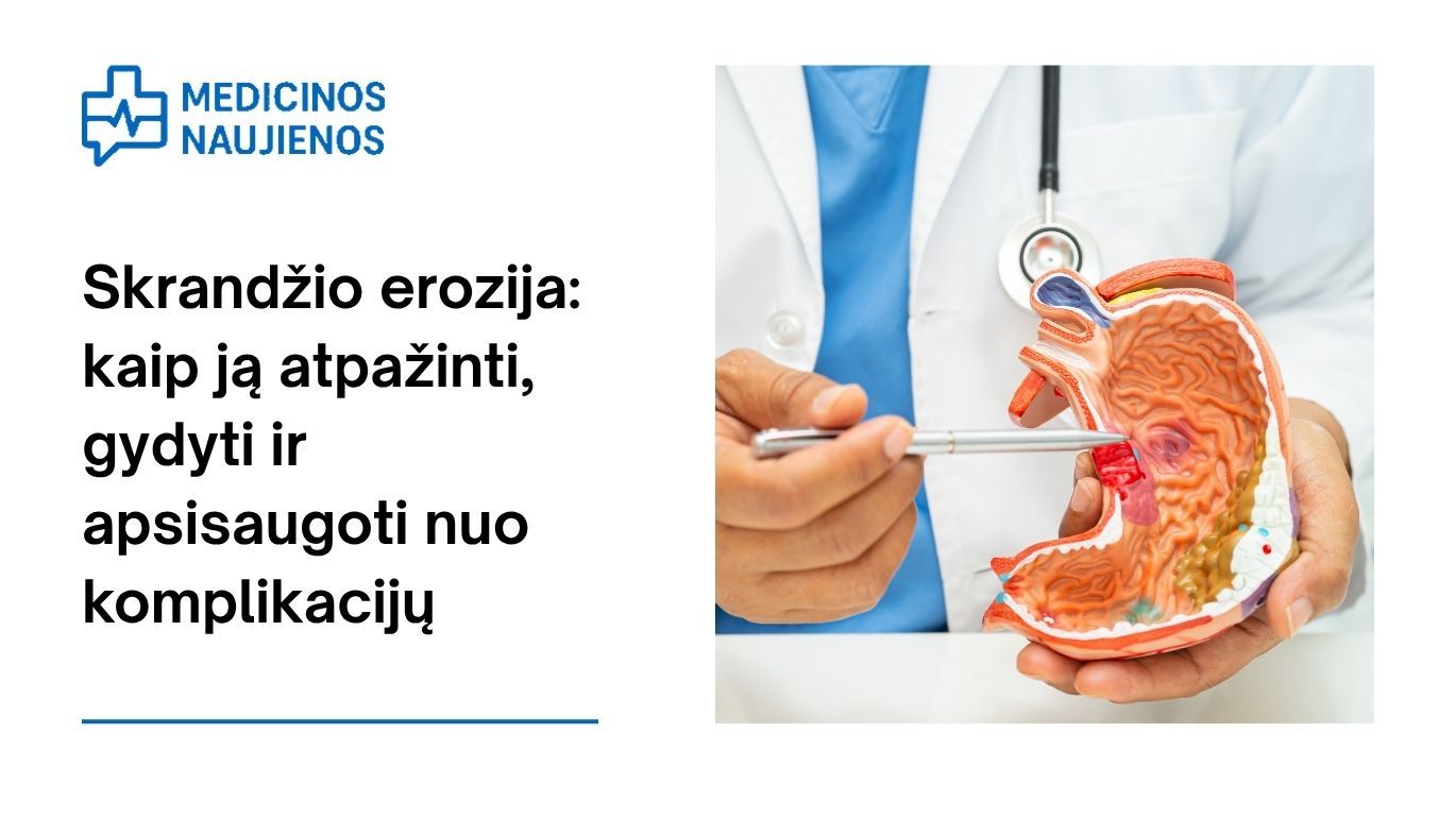 Skrandžio erozija: kaip ją atpažinti, gydyti ir apsisaugoti nuo komplikacijų