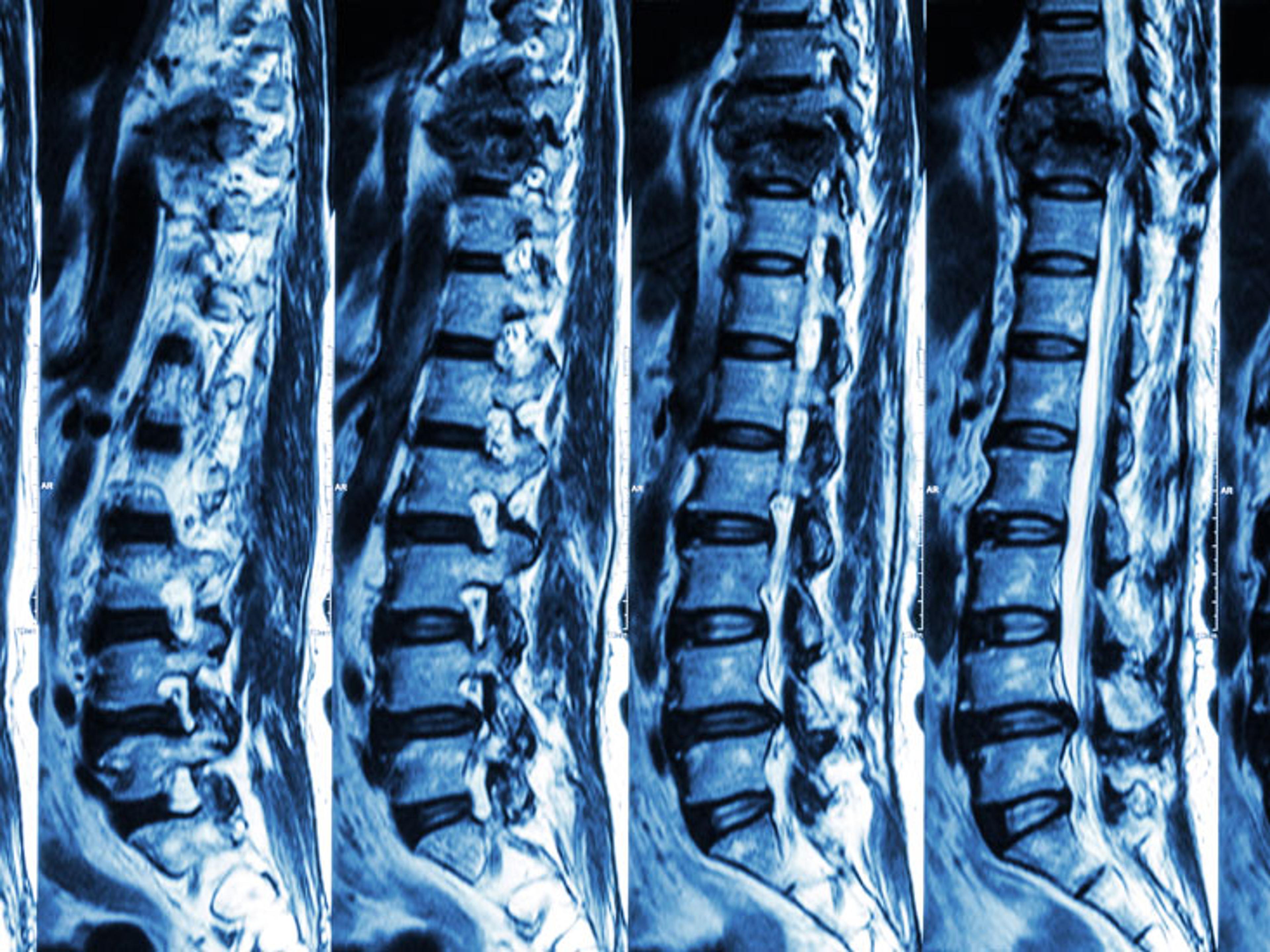 A CT scan of a spine, made up of many 2D “slices”