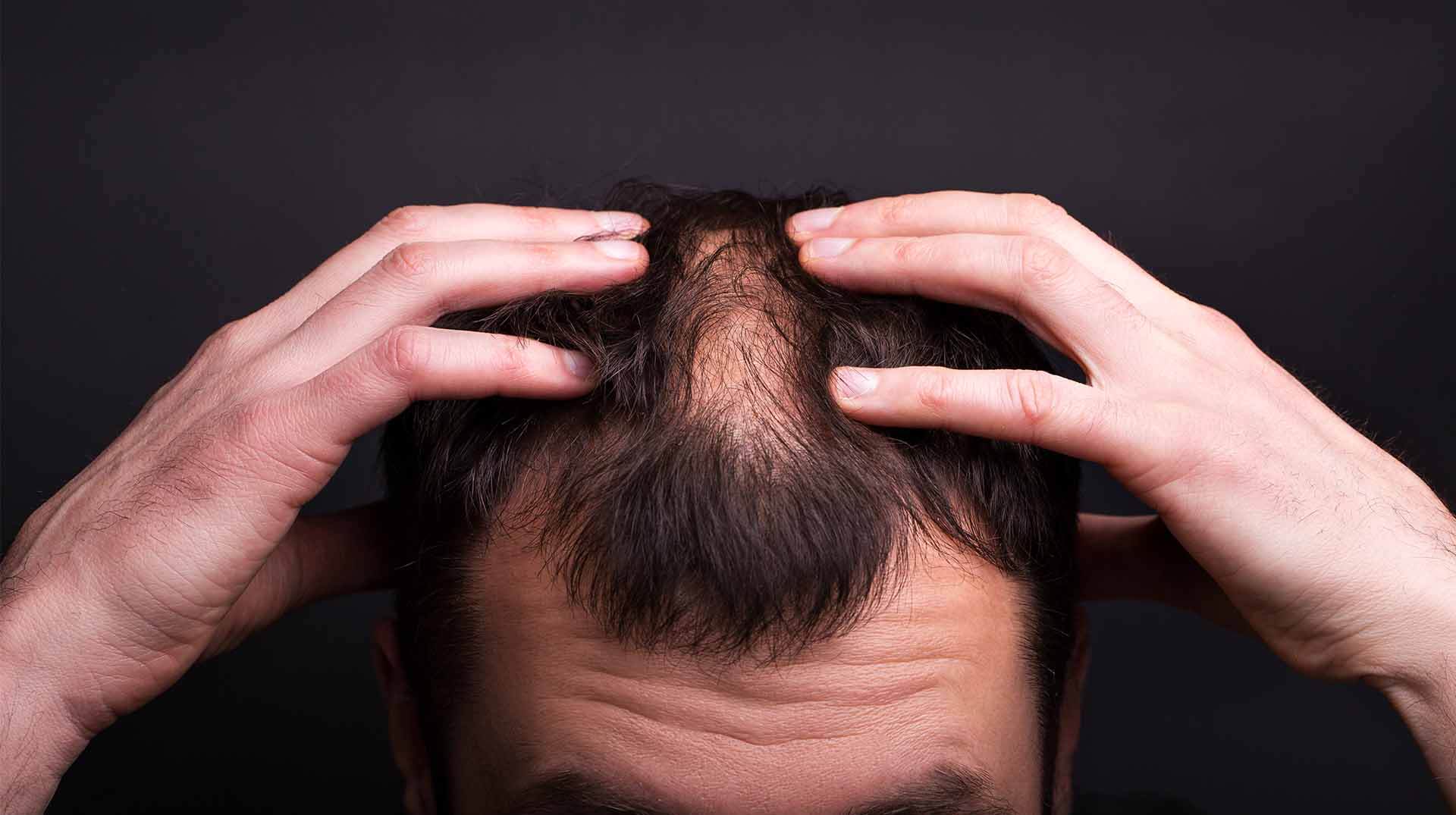 Mann-mit-Haarausfall-rauft-sich-die-Haare