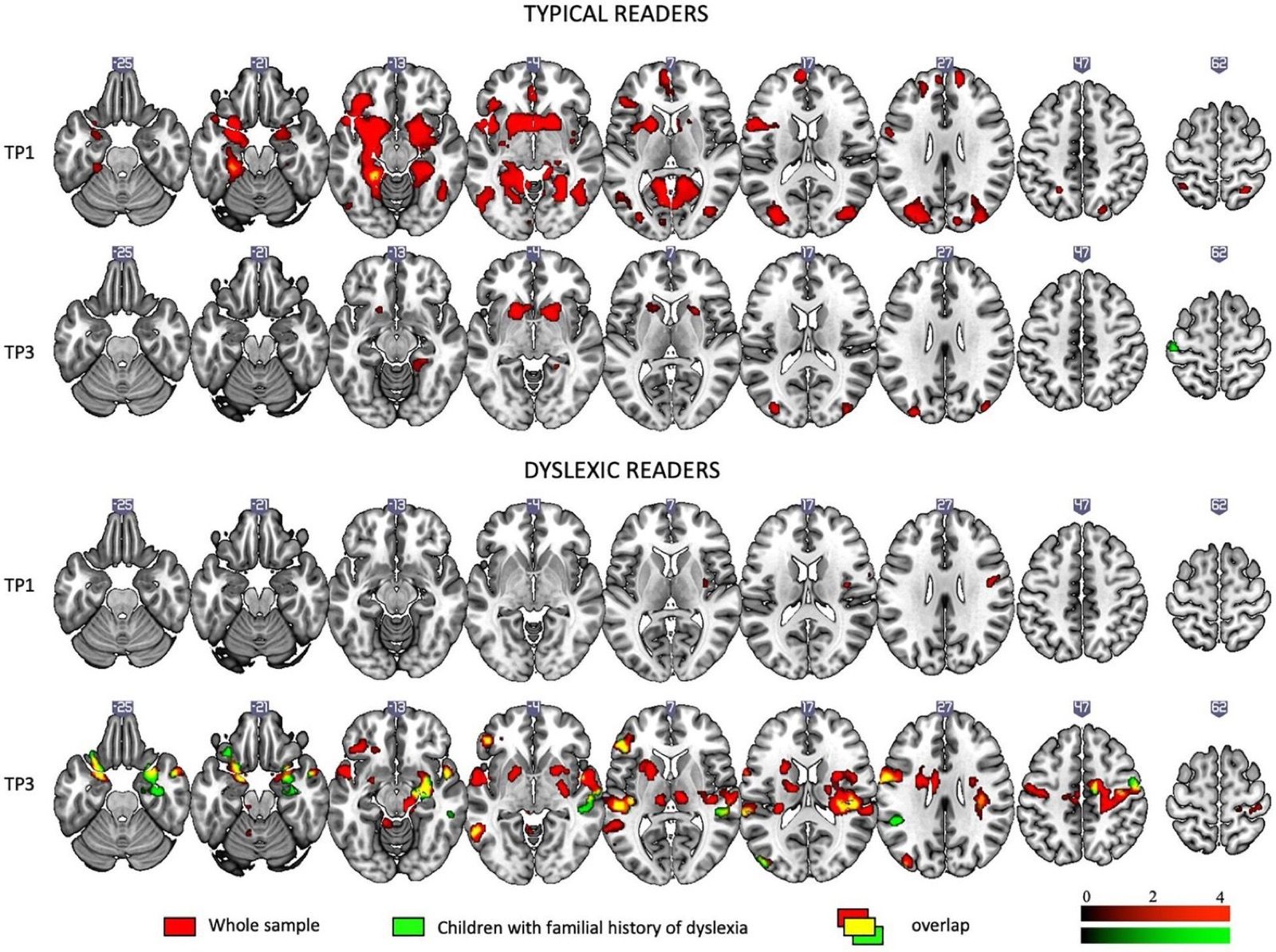 The Neuroscience Behind Dyslexia: What the Latest Research Reveals