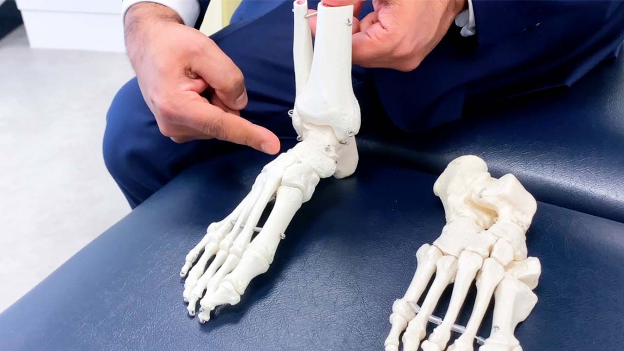 Compare my Care What are bunions and how do they develop?