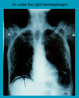 X-ray showing air under the right hemidiaphragm with a labeled arrow pointing to the affected area.