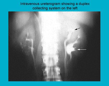 Intravenous urography image demonstrating a duplex kidney collecting system on the left side, highlighted with arrows.