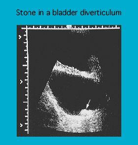 Ultrasound image showing a stone in a bladder diverticulum with labeled measurements