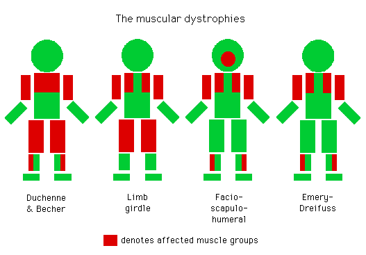 Illustration showing four types of muscular dystrophies and affected muscle groups, color-coded with red representing afflicted areas in silhouette figures representing Duchenne & Becker, Limb girdle, Facio-scapulo-humeral, and Emery-Dreifuss.