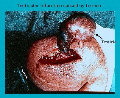 Medical image illustrating testicular infarction due to torsion, showcasing a swollen testicle with annotated features.
