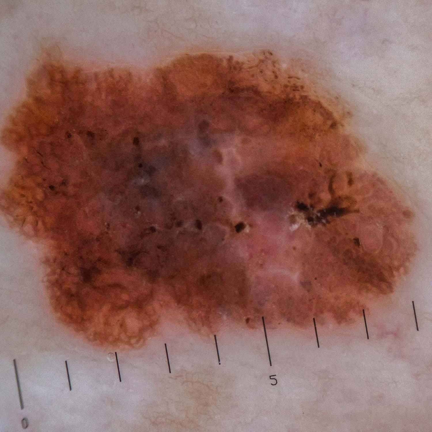 Dermatoscopic image of an irregular, multi-colored skin lesion with a measurement scale.