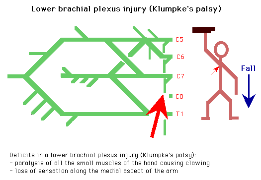 Diagram illustrating a lower brachial plexus injury (Klumpke's palsy) with nerve connections from C5 to T1 and their impact on arm function following a fall, including text descriptions of symptoms like paralysis and loss of sensation.