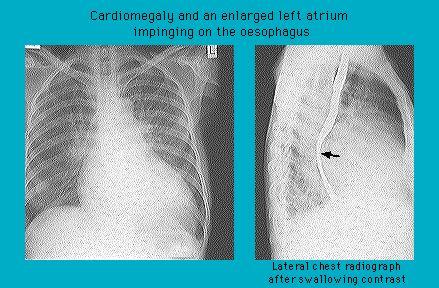 Two medical chest X-ray images displaying cardiomegaly and an enlarged left atrium impinging on the esophagus, one frontal view and one lateral view with swallowed contrast highlighting the impingement.