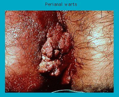 Close-up medical image showing perianal warts near the anus with visible skin inflammation and hair