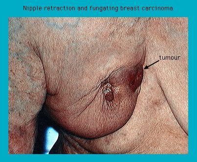 Close-up image of a breast with nipple retraction and visible fungating carcinoma highlighted by an arrow pointing at the tumor.
