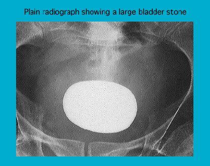 Plain radiograph of a human pelvis showing a large, oval bladder stone