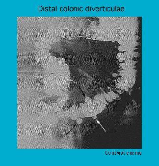 X-ray image showing distal colonic diverticulae from a contrast enema examination