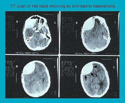 CT scan images of the head displaying an extradural hematoma in four sequential slices, labeled with 'R' for right and 'L' for left.