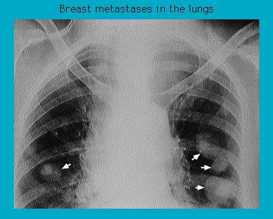 X-ray image showing breast metastases in the lungs with visible arrows pointing to the affected areas.