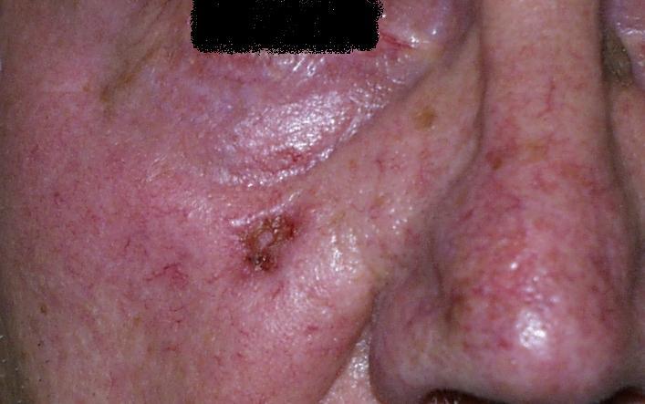 Close-up of a person's cheek and nose showing skin with rosacea and visible pores.
