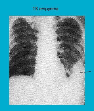 X-ray image showing a case of TB empyema with visible lung abnormalities and a marked area with an arrow.