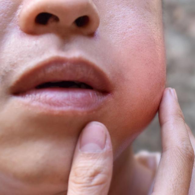 A person's hand touches their red, swollen cheek.