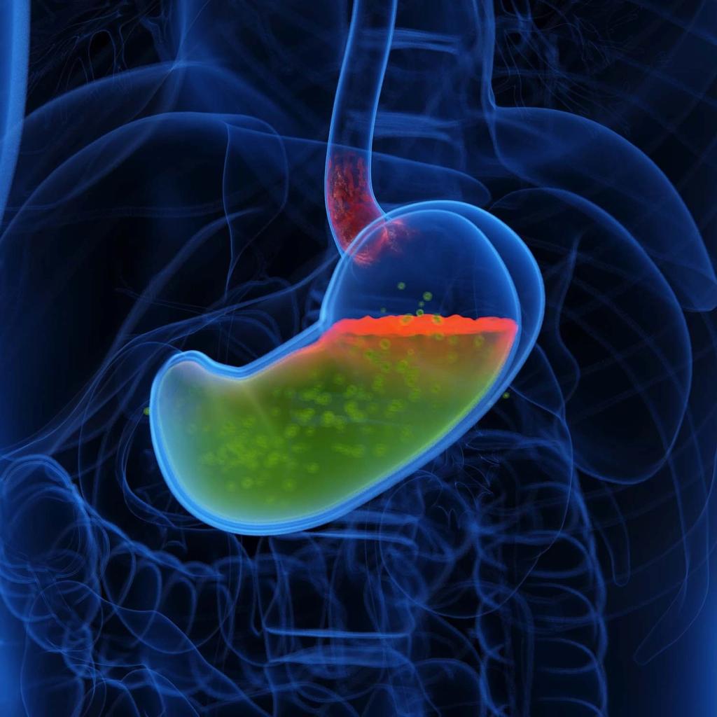 3D medical illustration of acid reflux, showing a red acid layer in a transparent stomach irritating the esophagus.