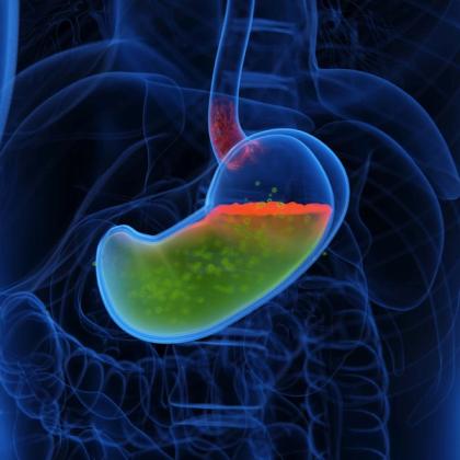 3D medical illustration of acid reflux, showing a red acid layer in a transparent stomach irritating the esophagus.