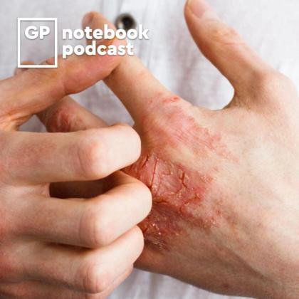 Close-up of hands examining a severe skin rash or infection on a hand, with the logo for GP Notebook Podcast visible