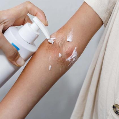Person applying cream to their irritated skin from a dispenser bottle.